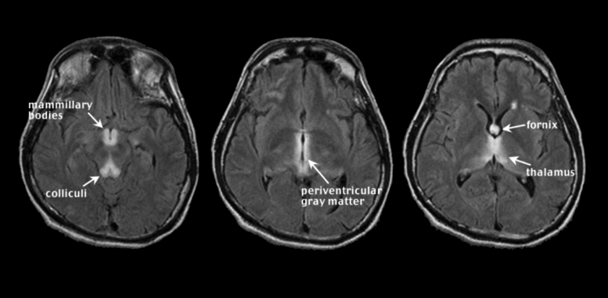 Graphic showing Wernick’s encephalopathy (WE). In acute WE, magnetic resonance imaging (MRI) can detect symmetrical, bilateral hyperintense foci, visible on T2-weighted and fluid attenuation inversion recovery (FLAIR) images, in periaqueductal gray matter, mammillary bodies, and tissue surrounding the third ventricle.