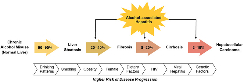 Figure 1 is a flowchart showing the spectrum of alcohol-associated liver disease, from steatosis to cirrhosis complicated by hepatocellular carcinoma.