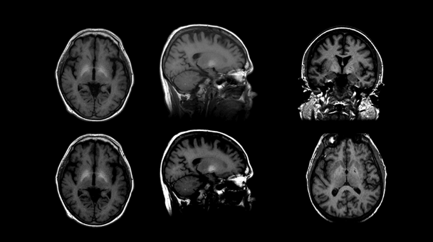 Graphic showing Hepatic encephalopathy (HE). T1-weighted imaging in HE reveals bilateral, symmetrical, high-intensity signals in basal ganglia structures, particularly the globus pallidus and substantia nigra, probably due to manganese deposition and T1 shortening. T2-weighted fluid attenuation inversion recovery (FLAIR) shows hyperintense signals along the corticospinal tract and diffuse hyperintense white matter signal in the cerebral hemispheres.