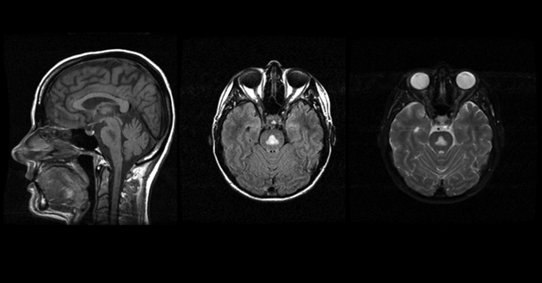Graphic showing Central pontine myelinolysis (CPM) is visualized as a hypointense T1 (left, sagittal slice) or hyperintense T2 (middle, right axial slices are early and late echo images) symmetric triangle or “bat-wing” lesion in the pons.