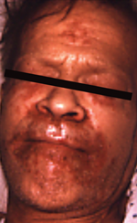 Graphic showing Chronic alcohol user who had been consuming large amounts of beer before admission. Note classical skin lesions of zinc deficiency around the eyes, nose, and mouth.